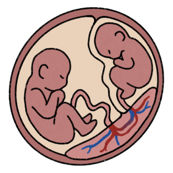 two twins pictured in the womb. Each floats in a pale amniotic sac. They share a placenta, and one is smaller and more cramped.